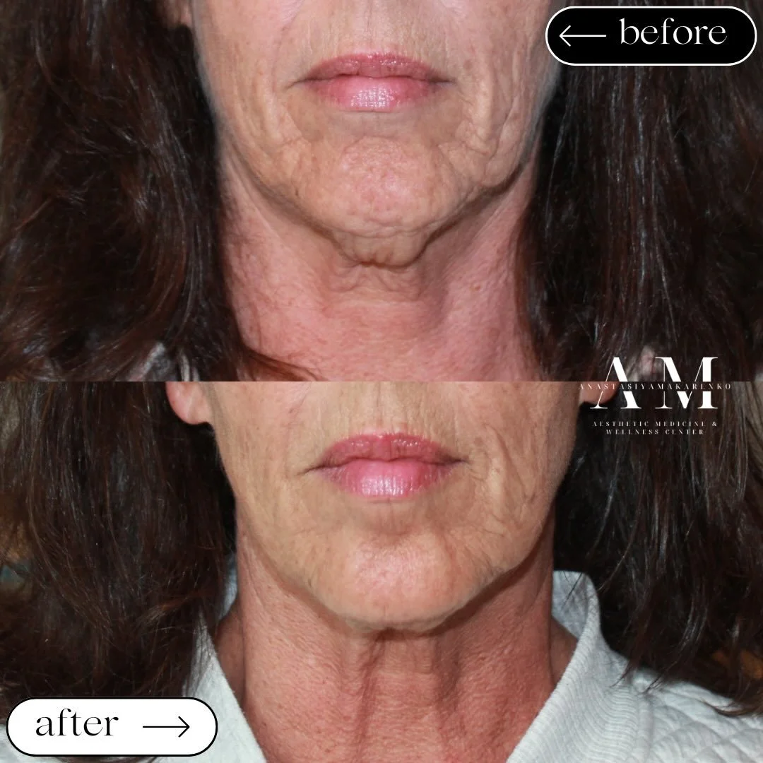 Let&rsquo;s talk neurotoxin treatment areas 💉

Forehead: ✔️
Crow&rsquo;s feet: ✔️
Lower face: &hellip;often neglected🙈

The lower face plays a HUGE role in how we age. DAO, jawline &amp; chin activity can drag the face down and create unwanted tens