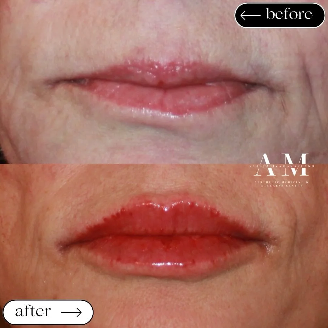 A little shape, a little volume, and a whole lot of balance💋

We focused on enhancing shape, balancing proportions, and adding soft volume for the prettiest result ✨

The goal will always be lips that fit you beautifully.

#lipfiller #beforeandafter