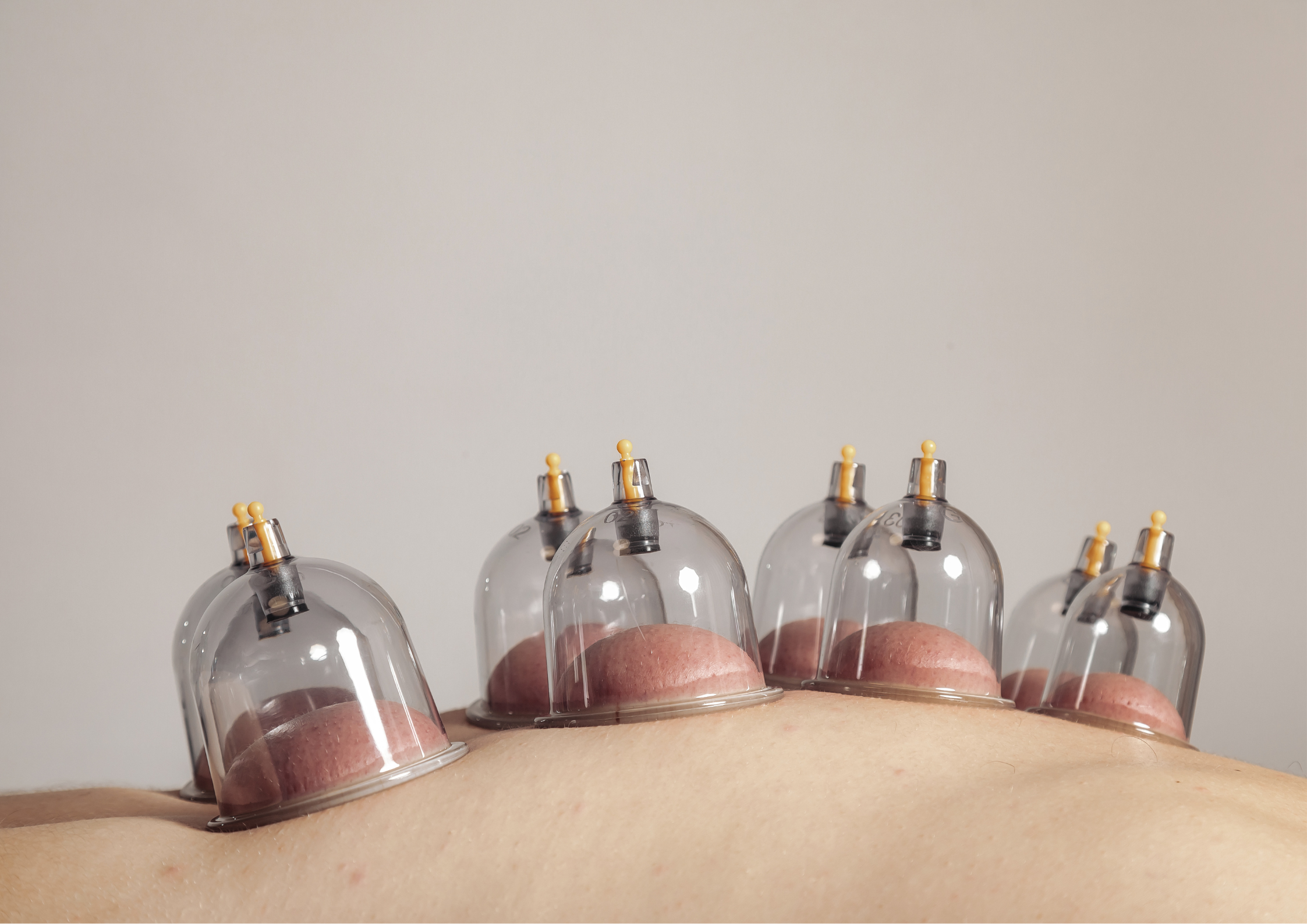 5 Benefits of Cupping Therapy Backed by Science
