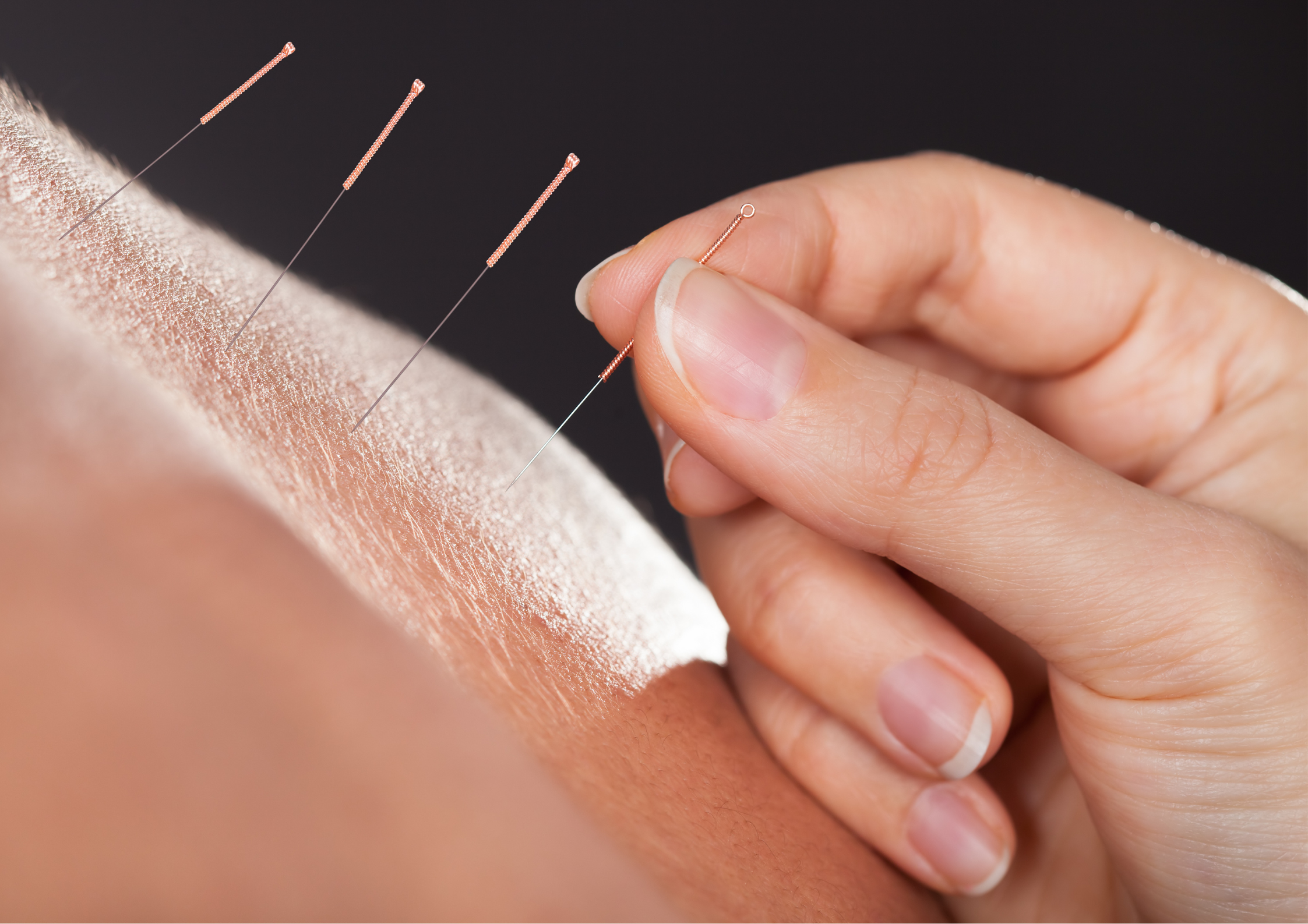 🪡 Does Acupuncture Hurt? What to Expect as a First-Time Patient