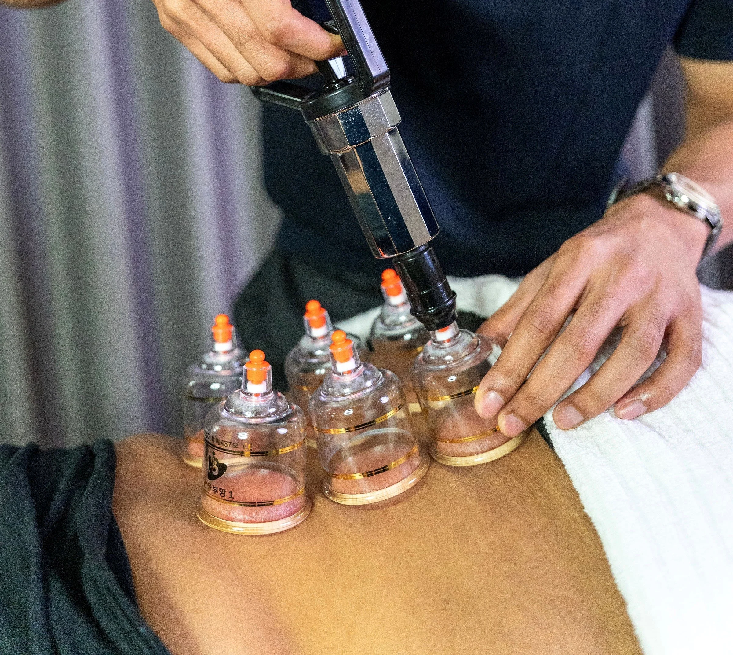 Therapeutic cupping therapy with four glass cups placed on bare skin.