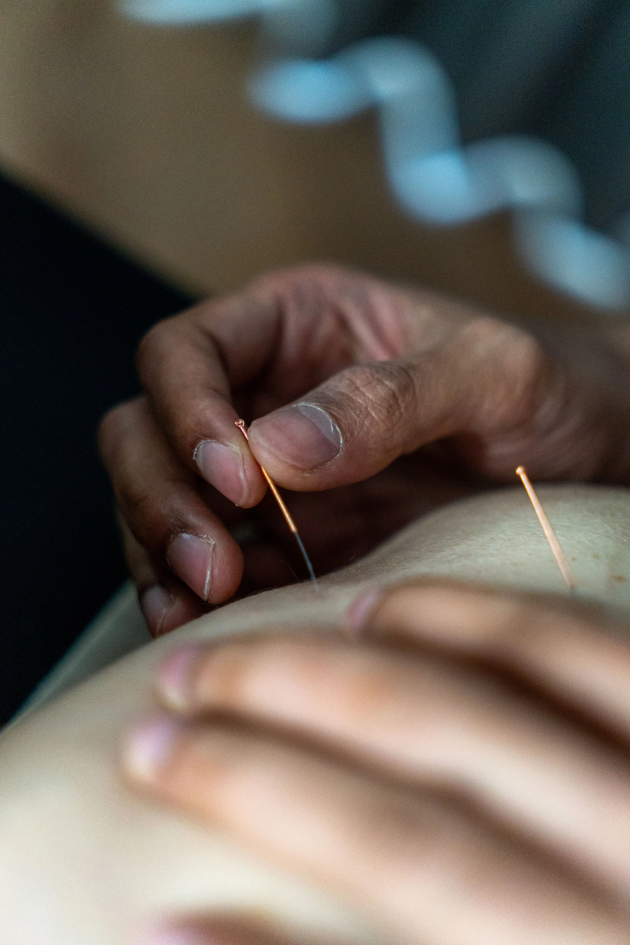 Close-up of a person receiving acupuncture treatment, with several acupuncture needles inserted into their back while a practitioner's hand rests on their shoulder.