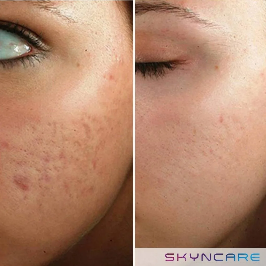 Side-by-side comparison of a person's face showing before and after treatment for acne scars, with the left side showing prominent scars and the right side showing clearer skin. The Aafiya Collective Blackburn, Lancashire