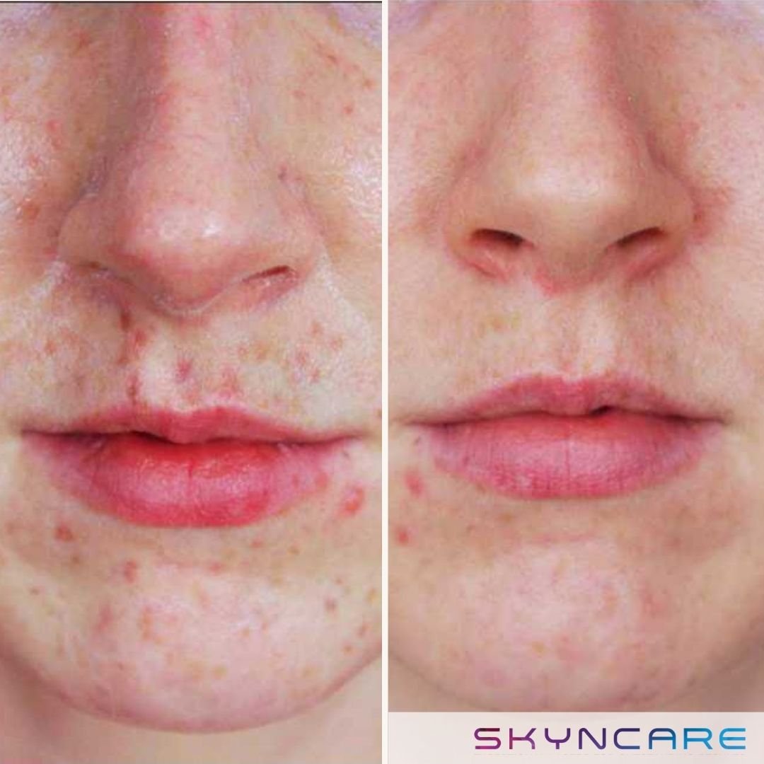 IPL Skin Rejuvenation - Acne Therapy