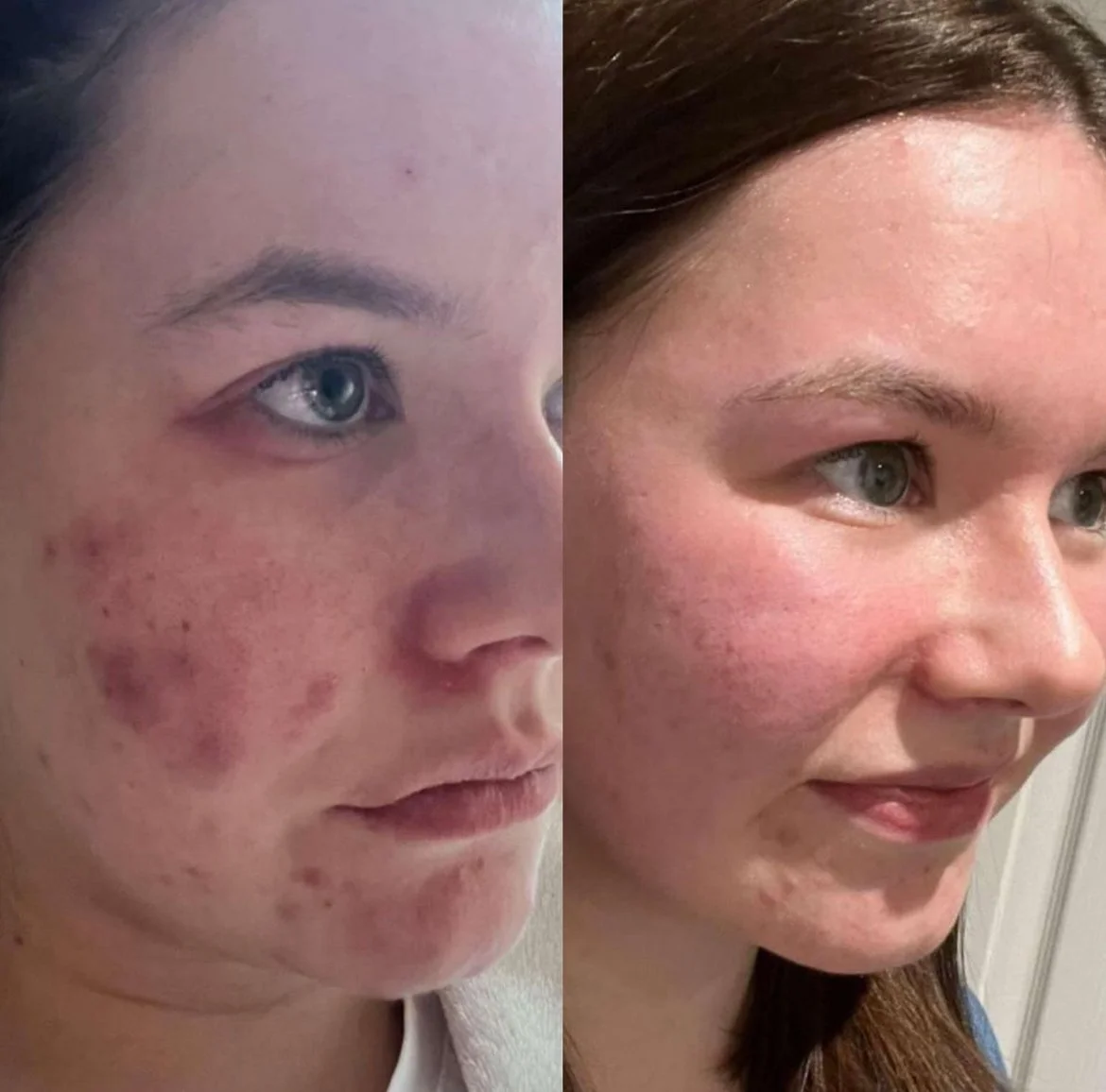 Million Dollar Facial Treatments