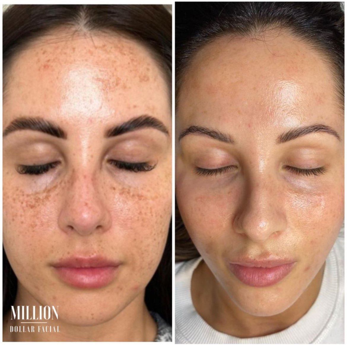 Product results - Hyper Erase