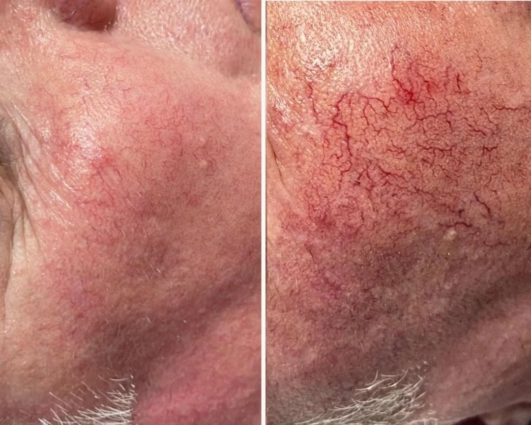 IPL - Vascular Treatment