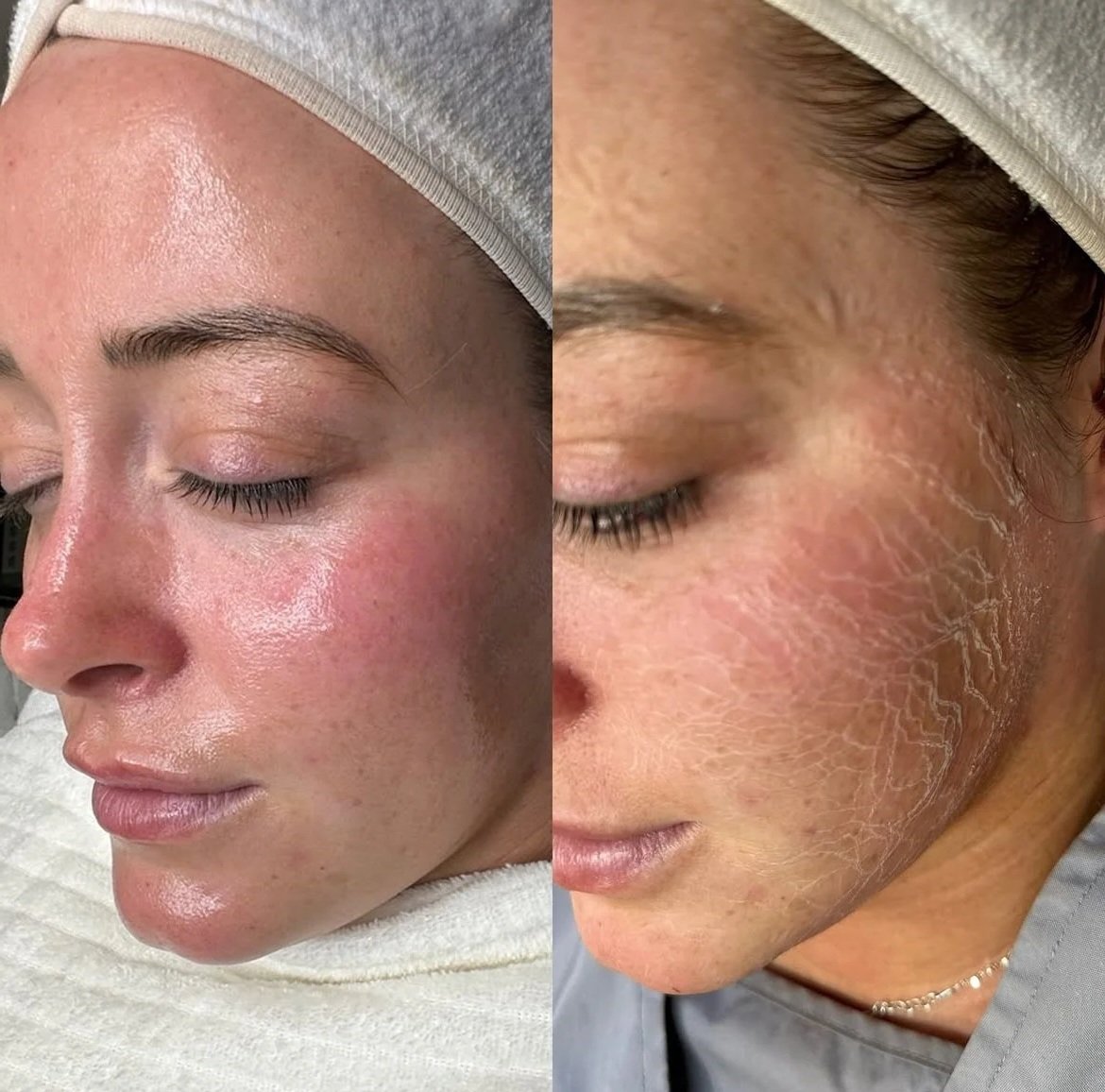 Million Dollar Facial Treatments