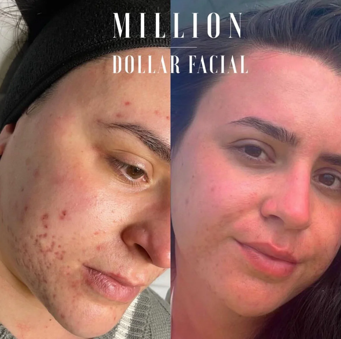 Million Dollar Facial Treatments