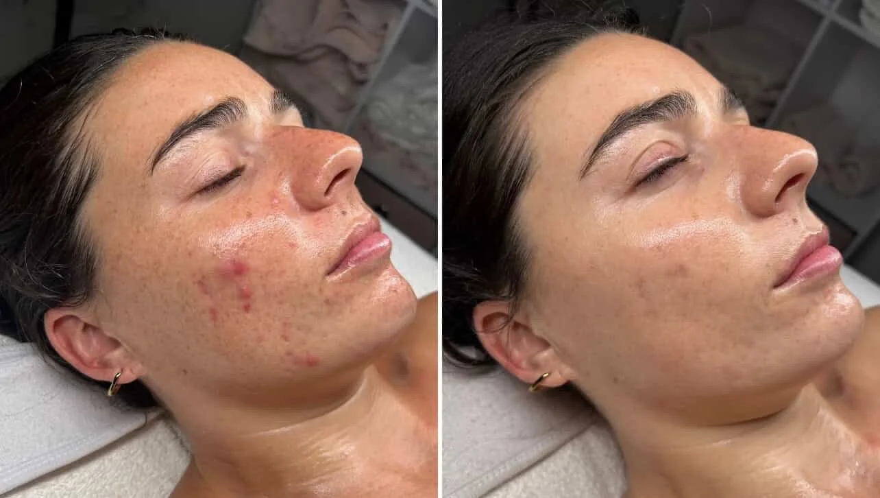 Product Results - Peels, Glyco Wash ha4c & Dermacleanse 