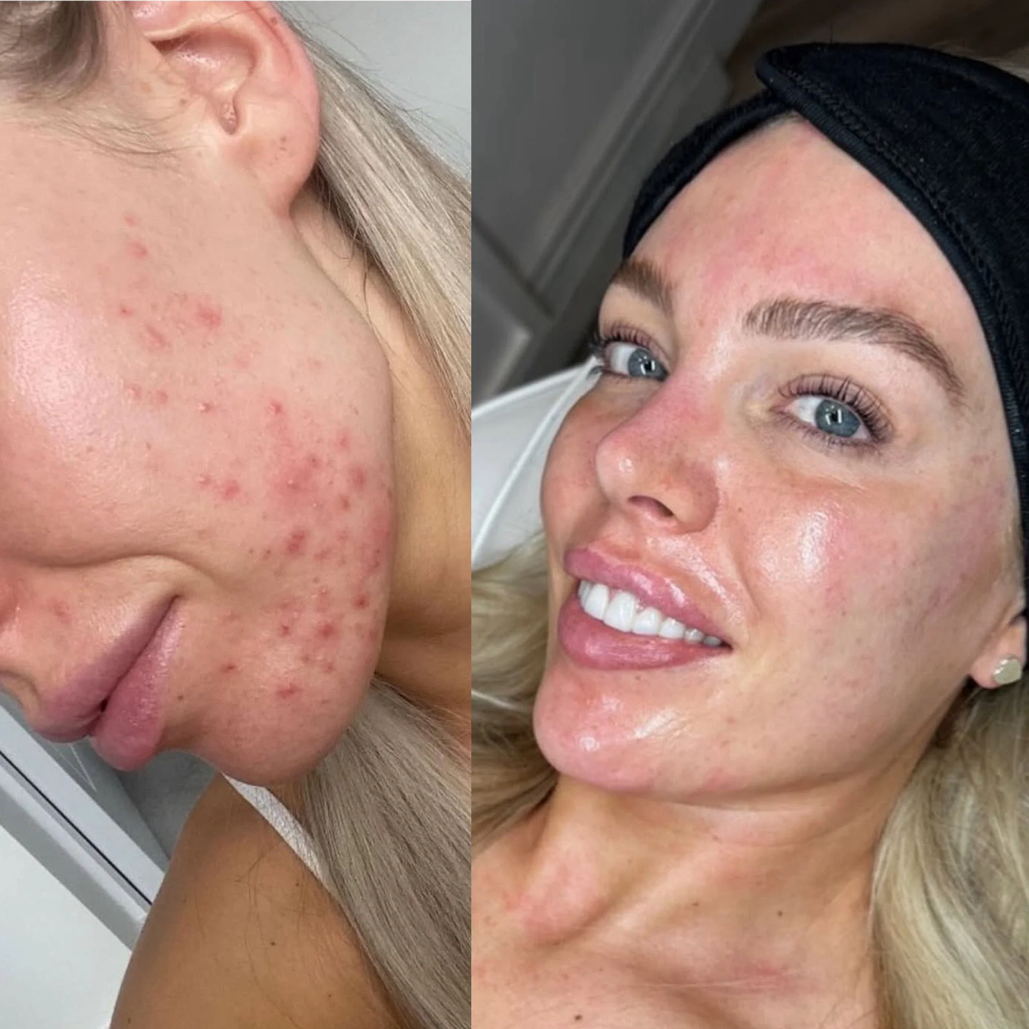 Million Dollar Facial Treatments