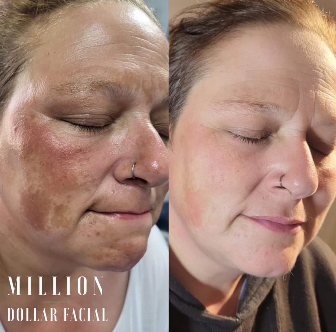Million Dollar Facial Treatments