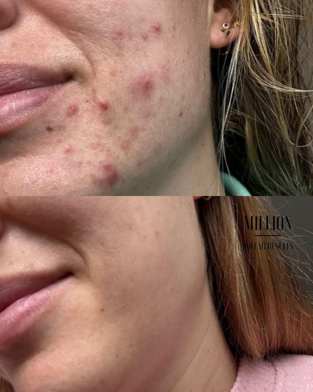 Million Dollar Facial Treatments