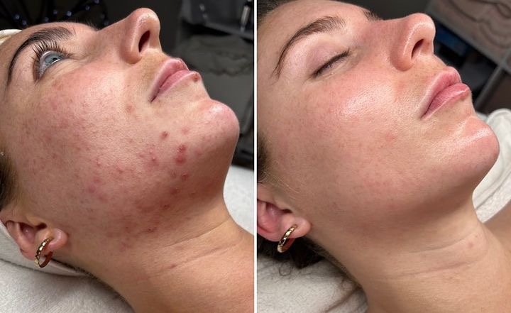 Million Dollar Facial Treatments