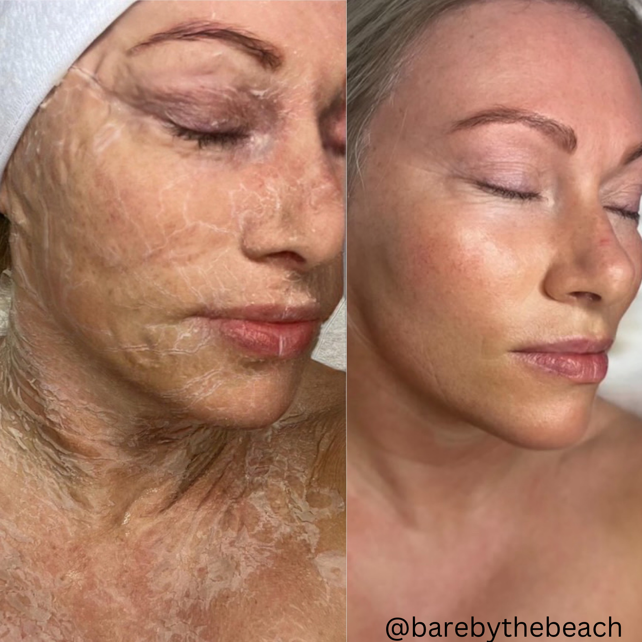 Million Dollar Facial Treatments