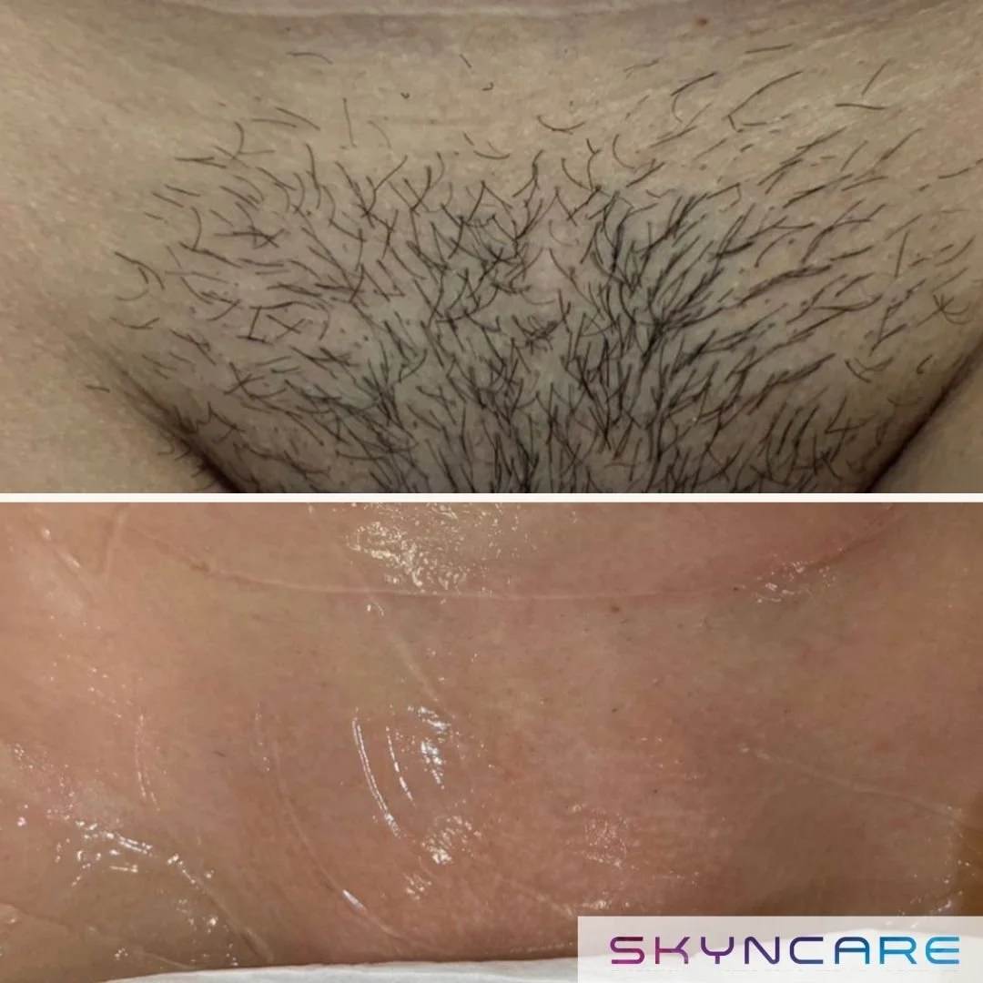 Comparison of skin: top shows a hairy, bottom shows smooth, clean skin with a skincare logo. The Aafiya Collective Blackburn, Lancashire