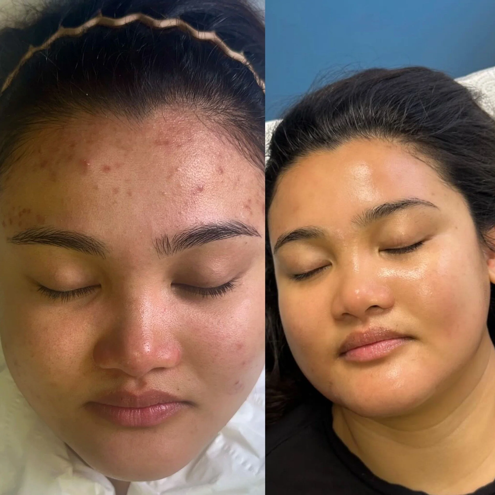 Million Dollar Facial treatments