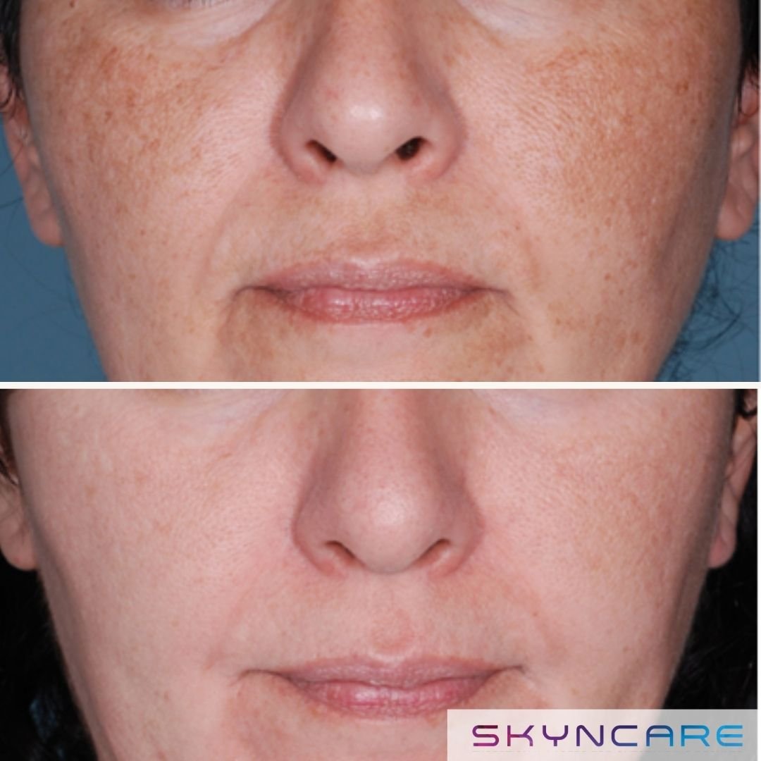 IPL - Pigmentation Treatment