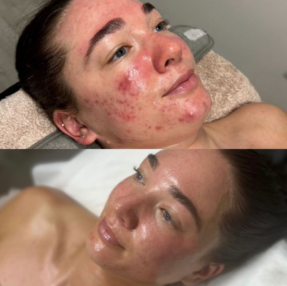 Million Dollar Facial Treatments