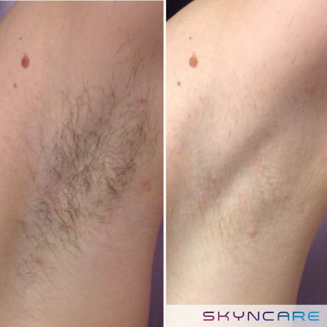 Laser Hair Removal