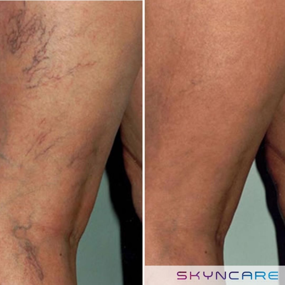 IPL - Vascular Treatment