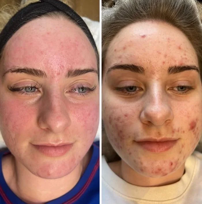 Million Dollar Facial Treatments