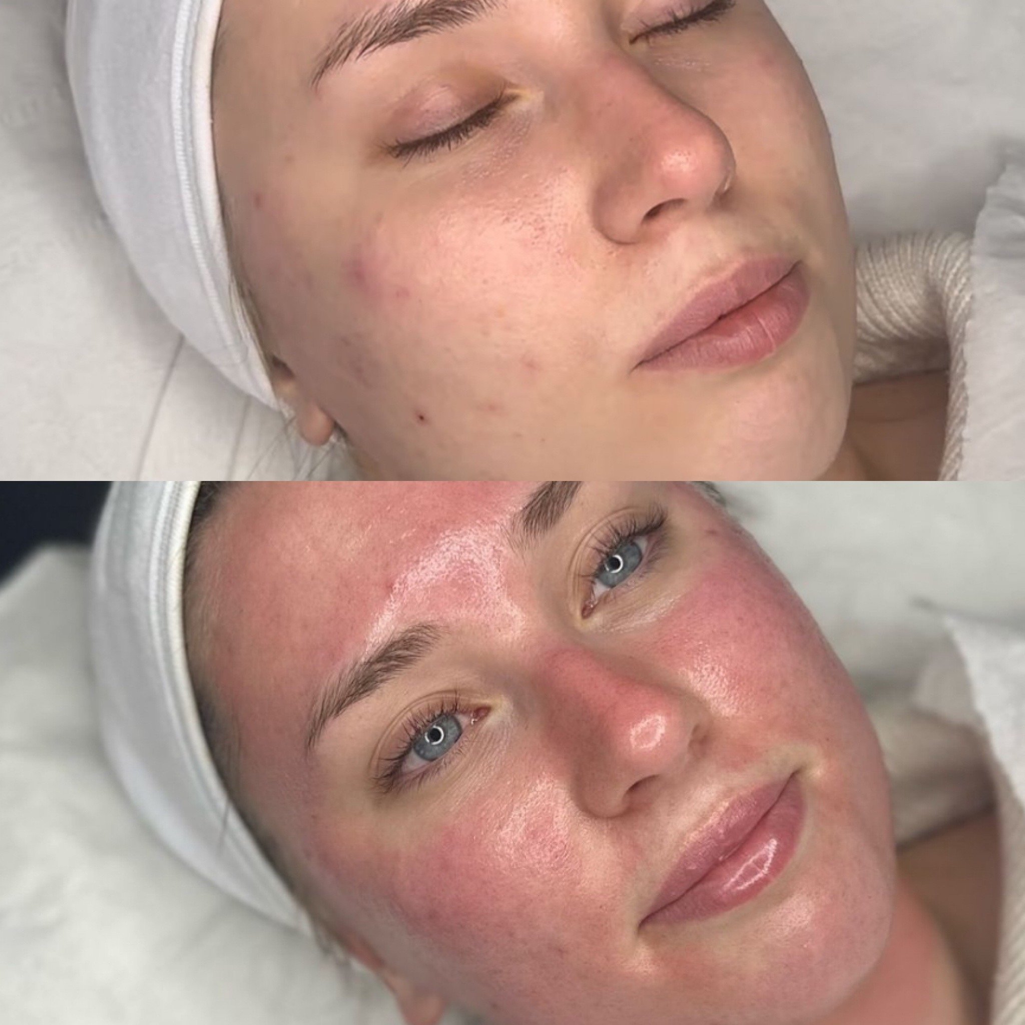 Million Dollar Facial Treatments