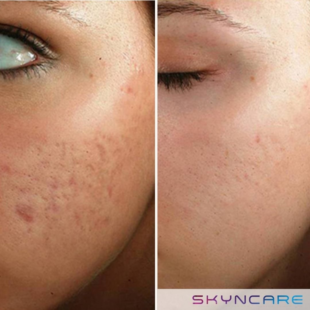 Laser Skin Resurfacing - Acne Scarring