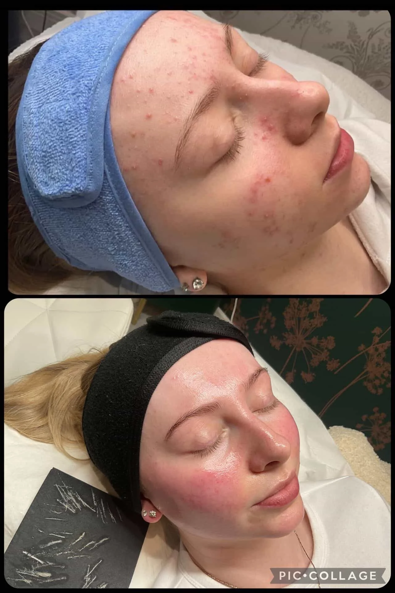 Product results - Acne Bundle