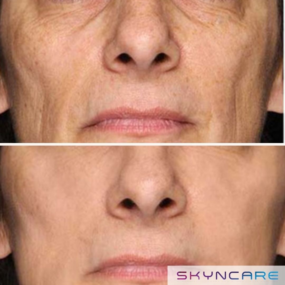 Close-up of a person's face showing before and after comparison, highlighting improved skin texture and reduced wrinkles. The Aafiya Collective Blackburn, Lancashire