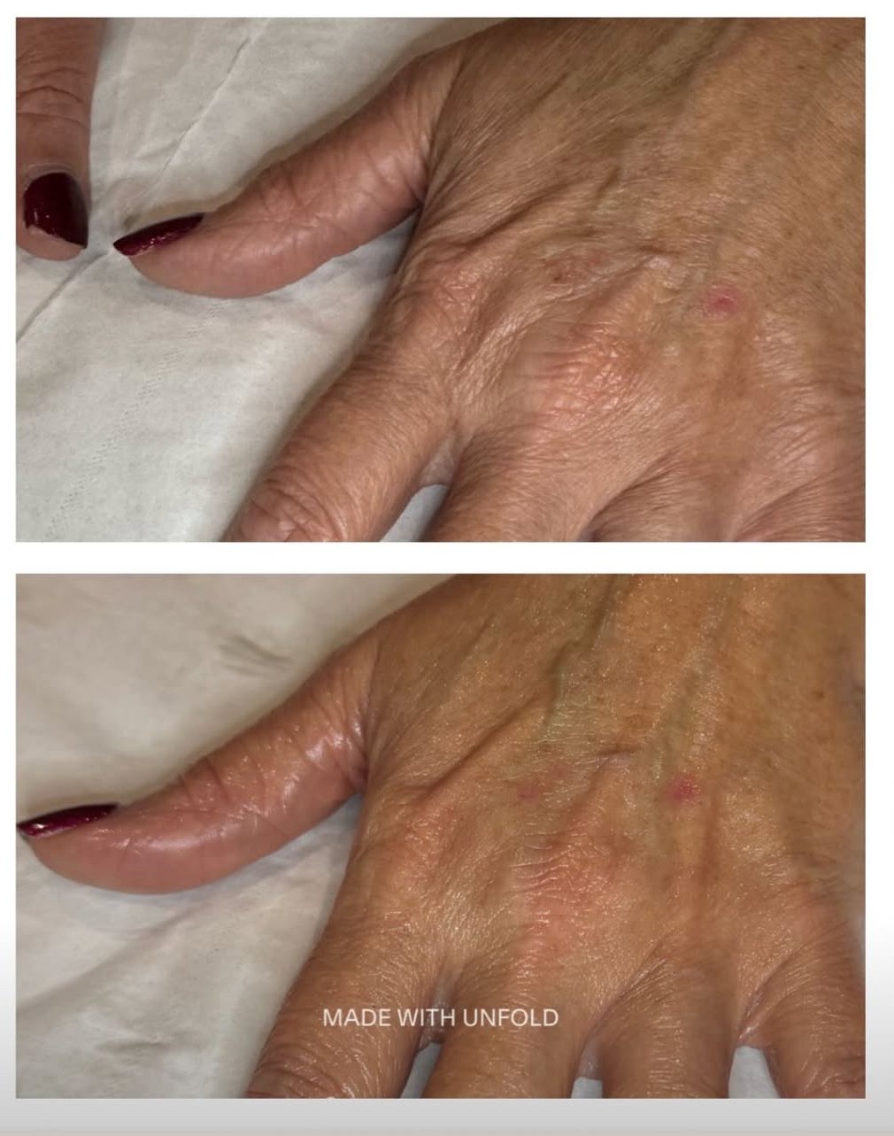 Million Dollar Hand Rejuvenation