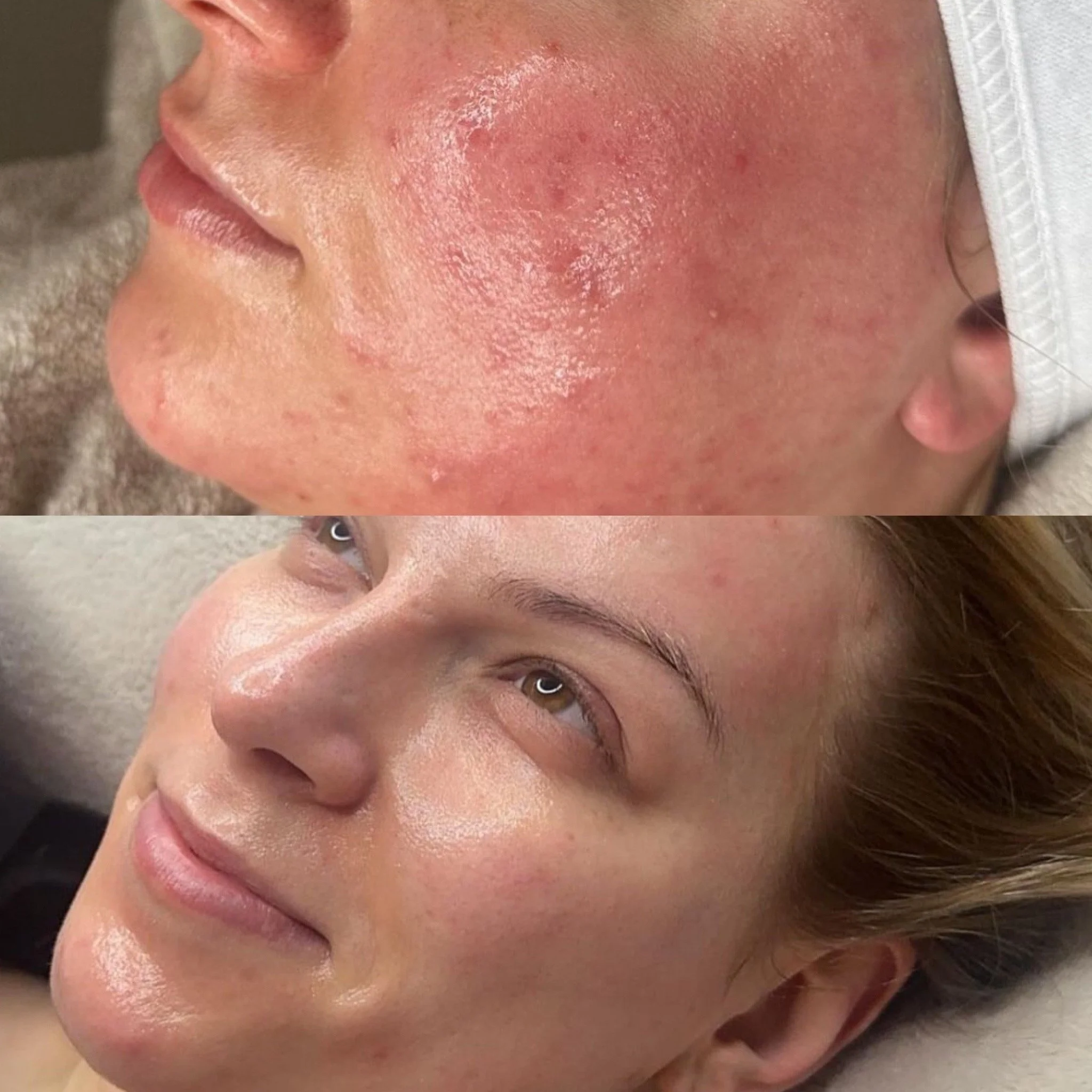 Million Dollar Facial Treatments