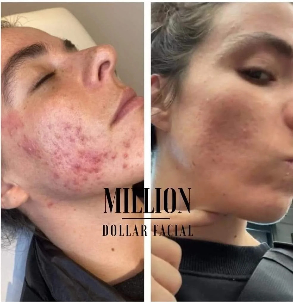 Million Dollar Facial Treatments