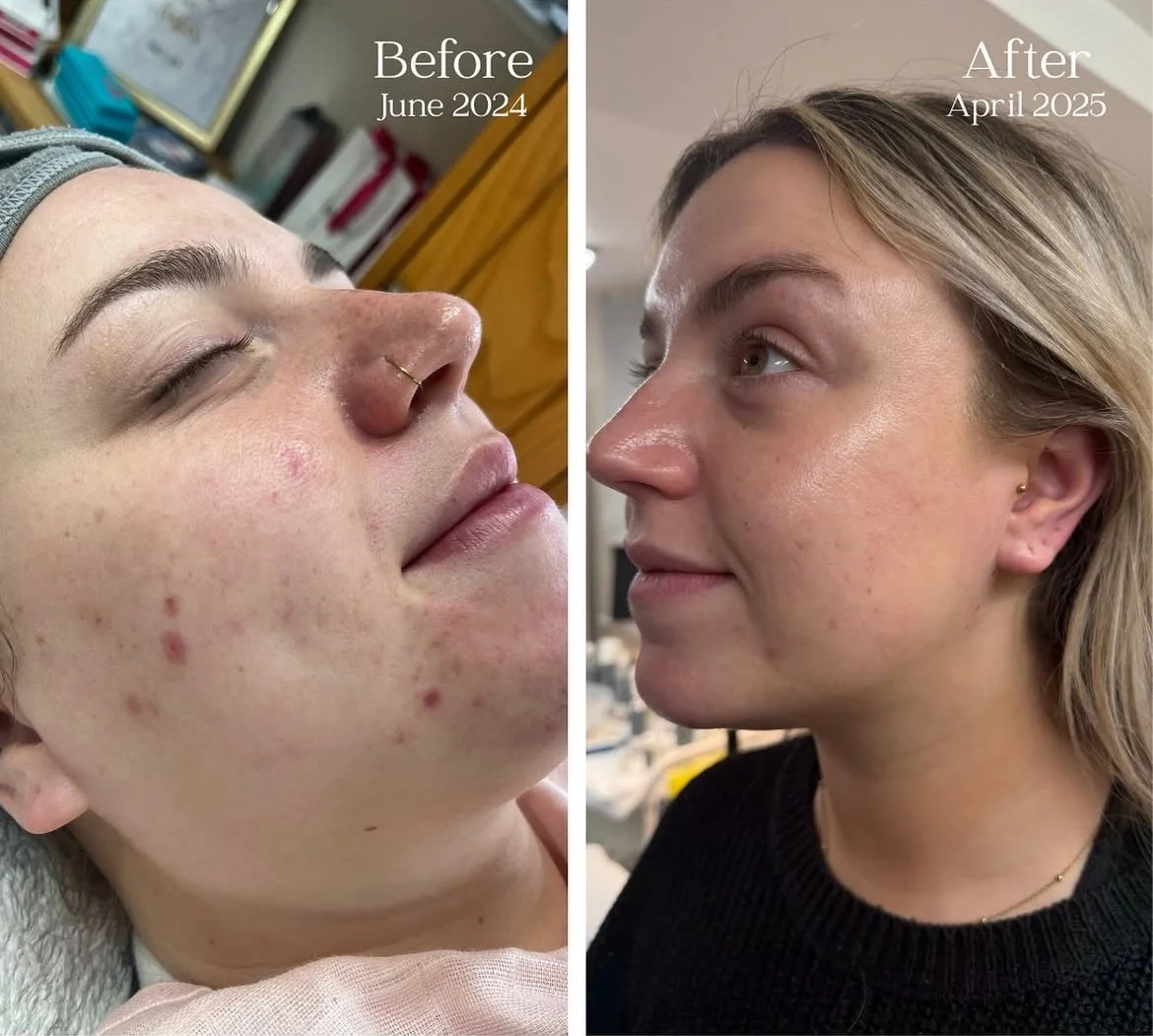 Million Dollar Facial Treatments