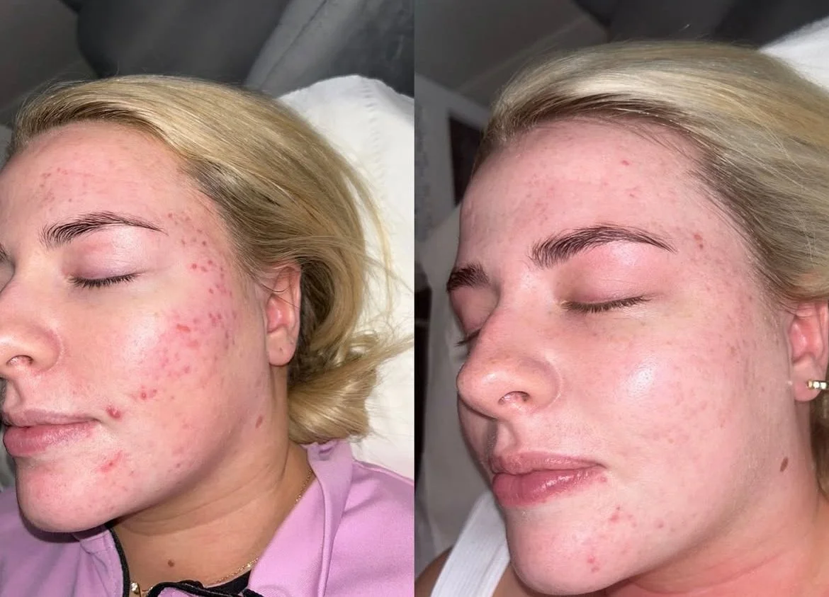 Million Dollar Facial Treatments