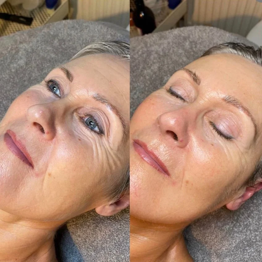 Million Dollar Facial Treatments