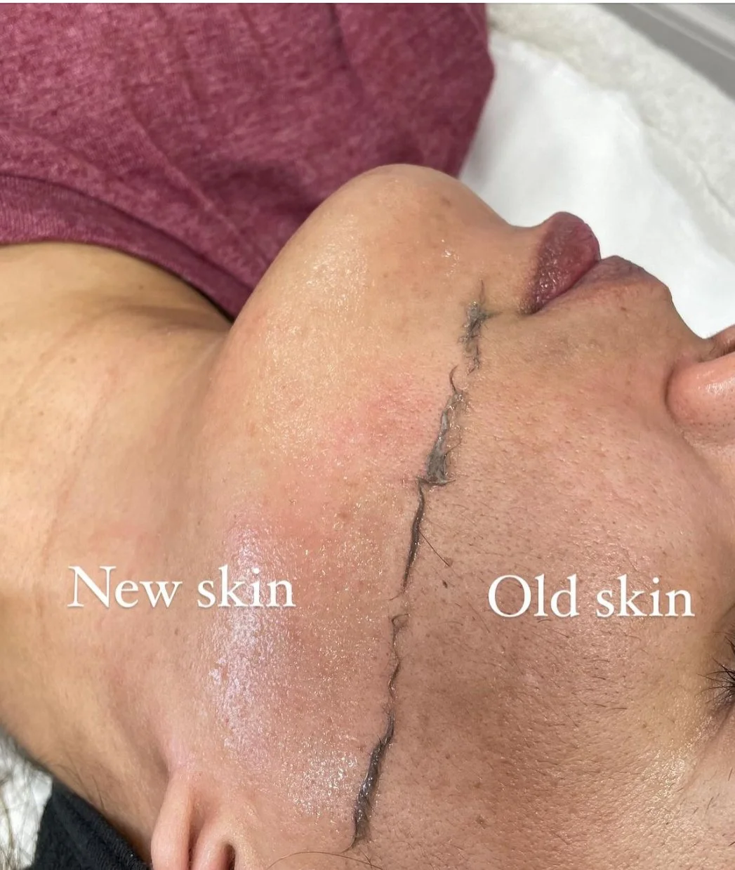 Million Dollar Dermaplaning