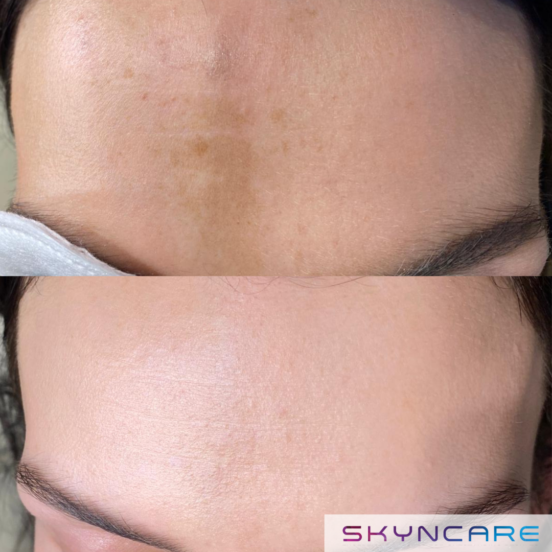 IPL - Pigmentation Treatment