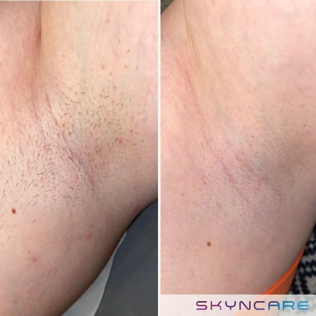 Side-by-side comparison photo showing a person's underarm before and after hair removal treatment; the left side shows hairy skin with visible hair, and the right side shows smooth, hair-free skin. The Aafiya Collective Blackburn, Lancashire