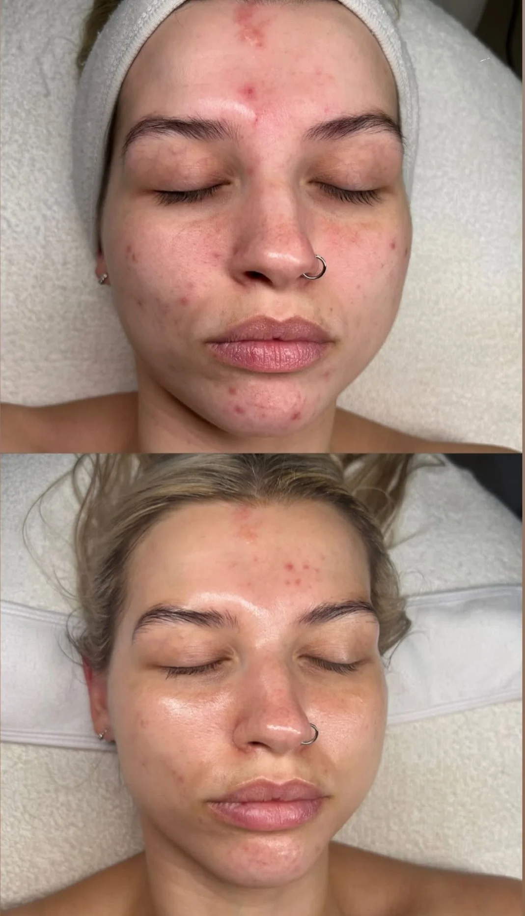 Million Dollar Facial Treatments