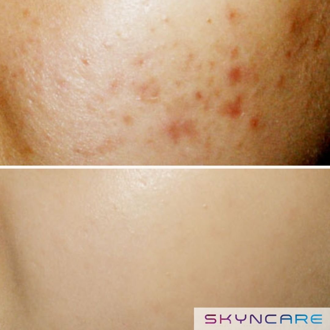 A before and after comparison of skin, showing reduction in redness, acne scars, and blemishes in the after image. The Aafiya Collective Blackburn, Lancashire