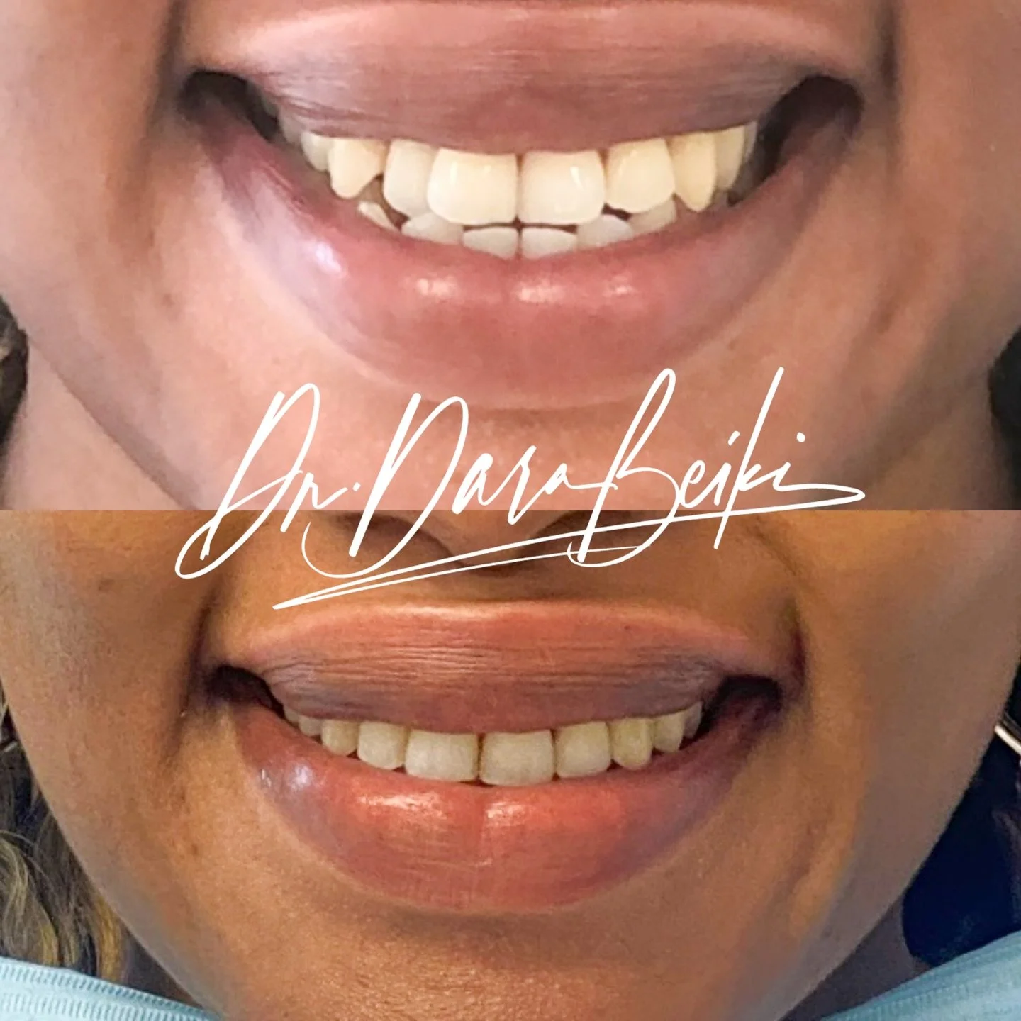 A beautiful transformation using Invisalign&reg; to correct a Class III bite and create a balanced, confident smile.

This case involved:
🦷 Extraction of wisdom teeth to create space
📐 Lower jaw distalisation to correct the bite relationship
😁 Inv