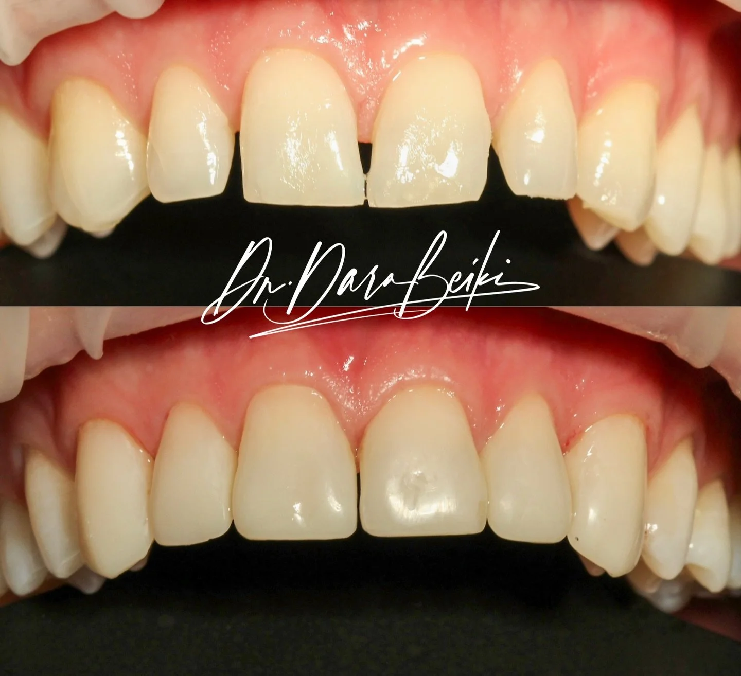 ✨ Composite Bonding at Baudelaire Dental Clinic ✨

Enhance your smile in just one visit. Composite bonding can repair chips, close gaps, and reshape teeth for a natural, confident smile&mdash;quick, comfortable, and minimally invasive.

📍 Book your 