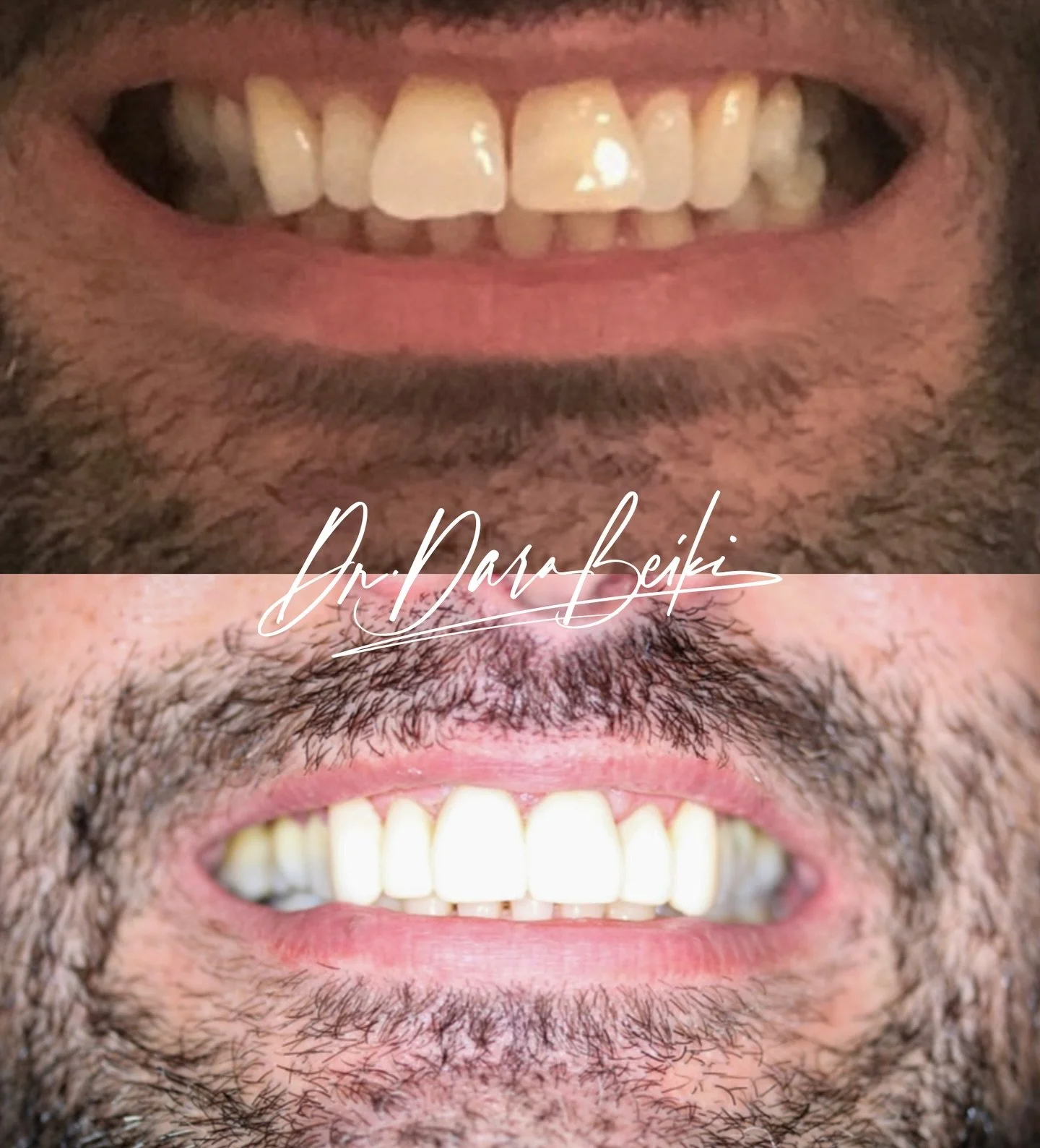 Real smile, real confidence ✨

This smile makeover was all about enhancing natural beauty while keeping everything subtle and authentic. We started with Invisalign to gently align the teeth, followed by professional whitening to brighten the overall 