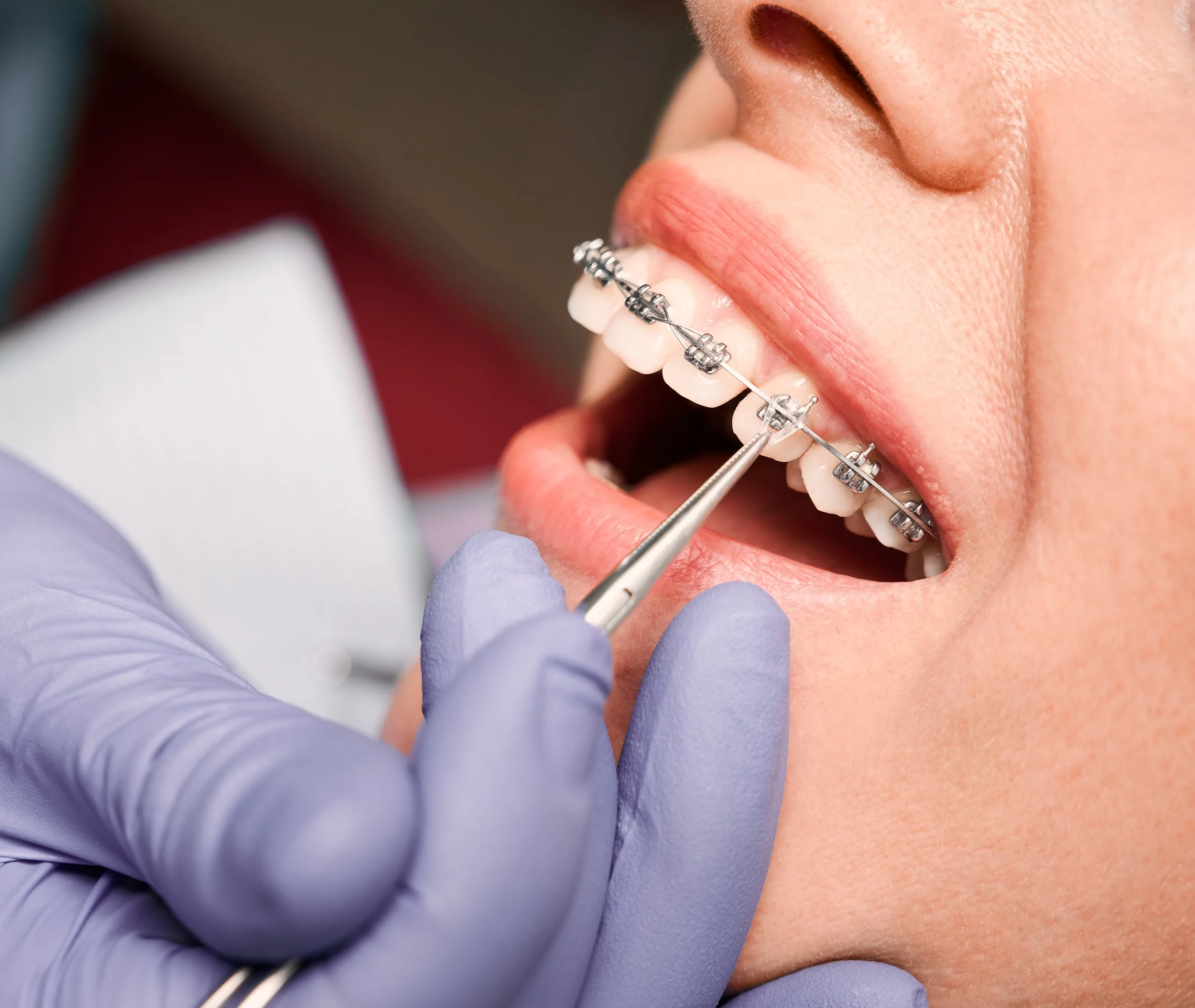 A close-up of a person with braces on their teeth and a dental tool being used by a gloved hand during an orthodontic procedure.