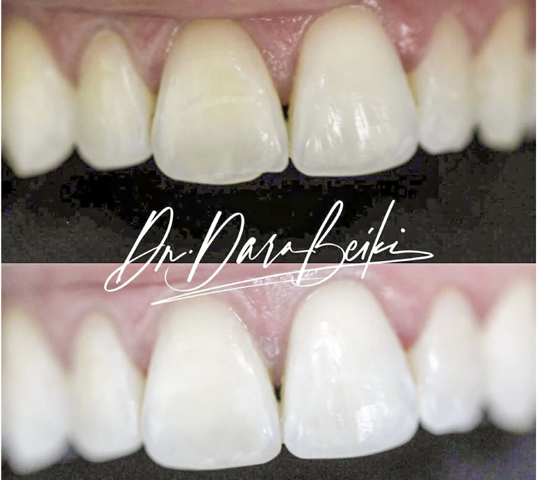 Close-up of a person's front upper teeth showing before and after dental whitening, with the name Dr. David Beiki overlayed.