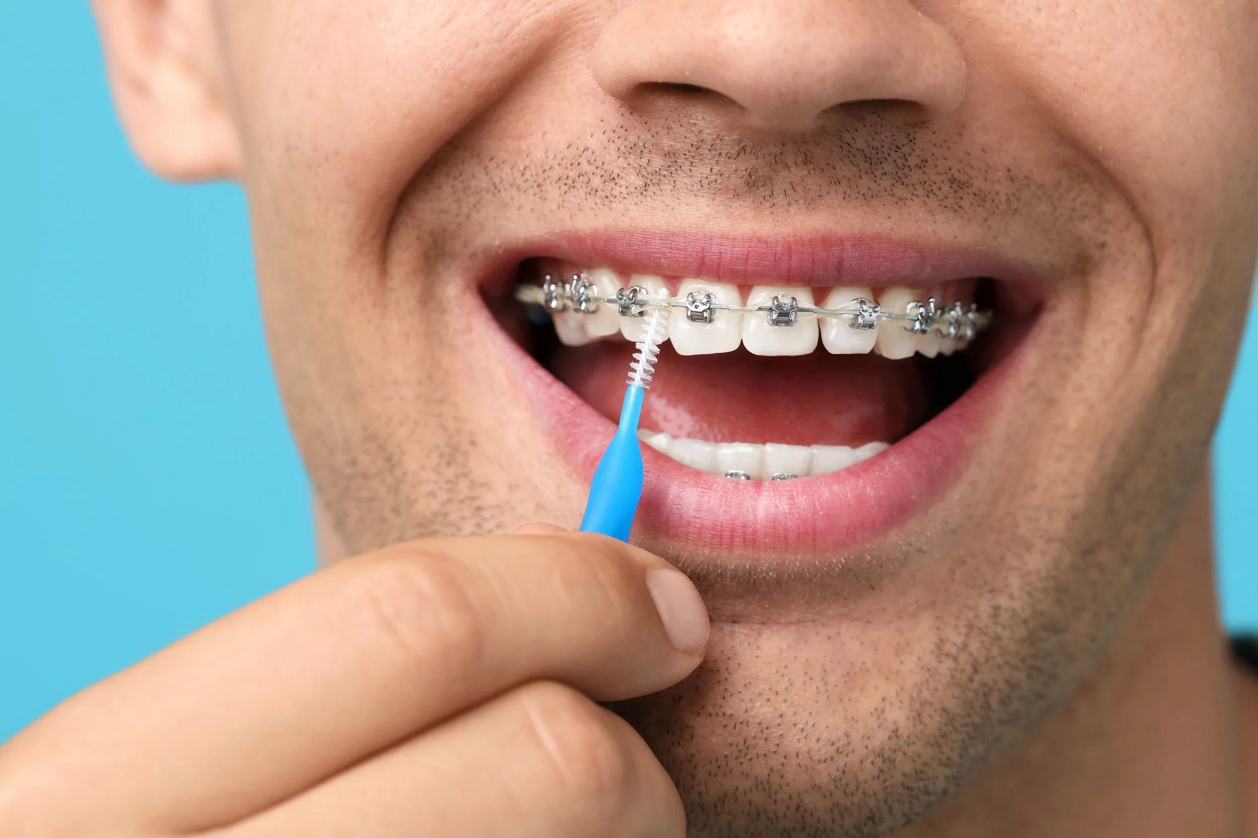 Person with braces cleaning their teeth with a blue interdental brush.