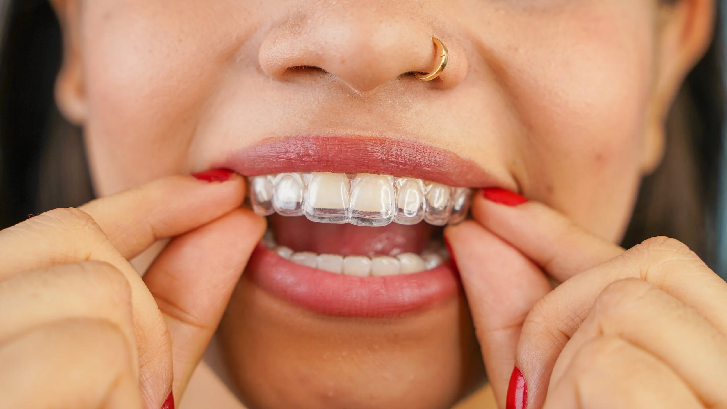 A woman showing clear dental aligners on her upper teeth while using her fingers to pull her lips back for a close-up view.