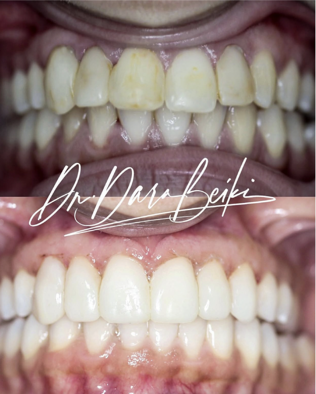 Close-up before-and-after images of teeth whitening, showing significant improvement in tooth color and brightness.