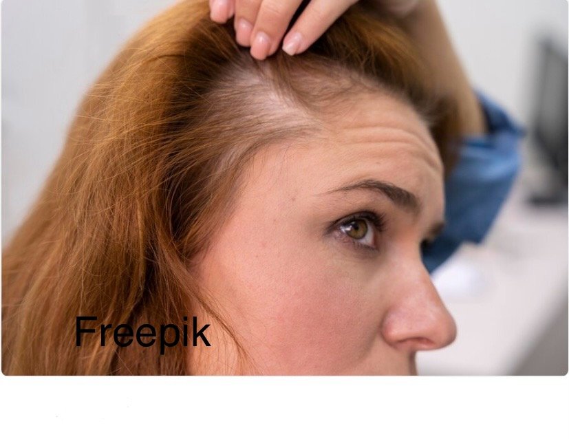 Hair Loss during Midlife